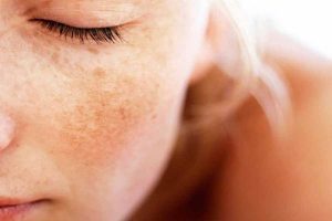 gia công serum trị nám