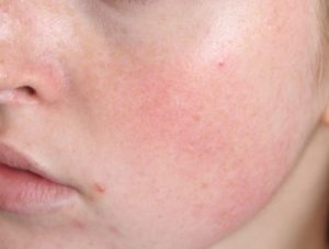 serum đào thải độc tố