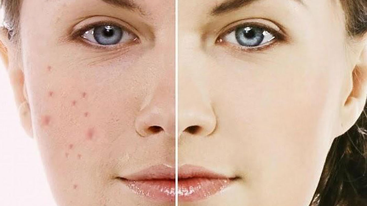 Gia công kem trị thâm mụn chất lượng